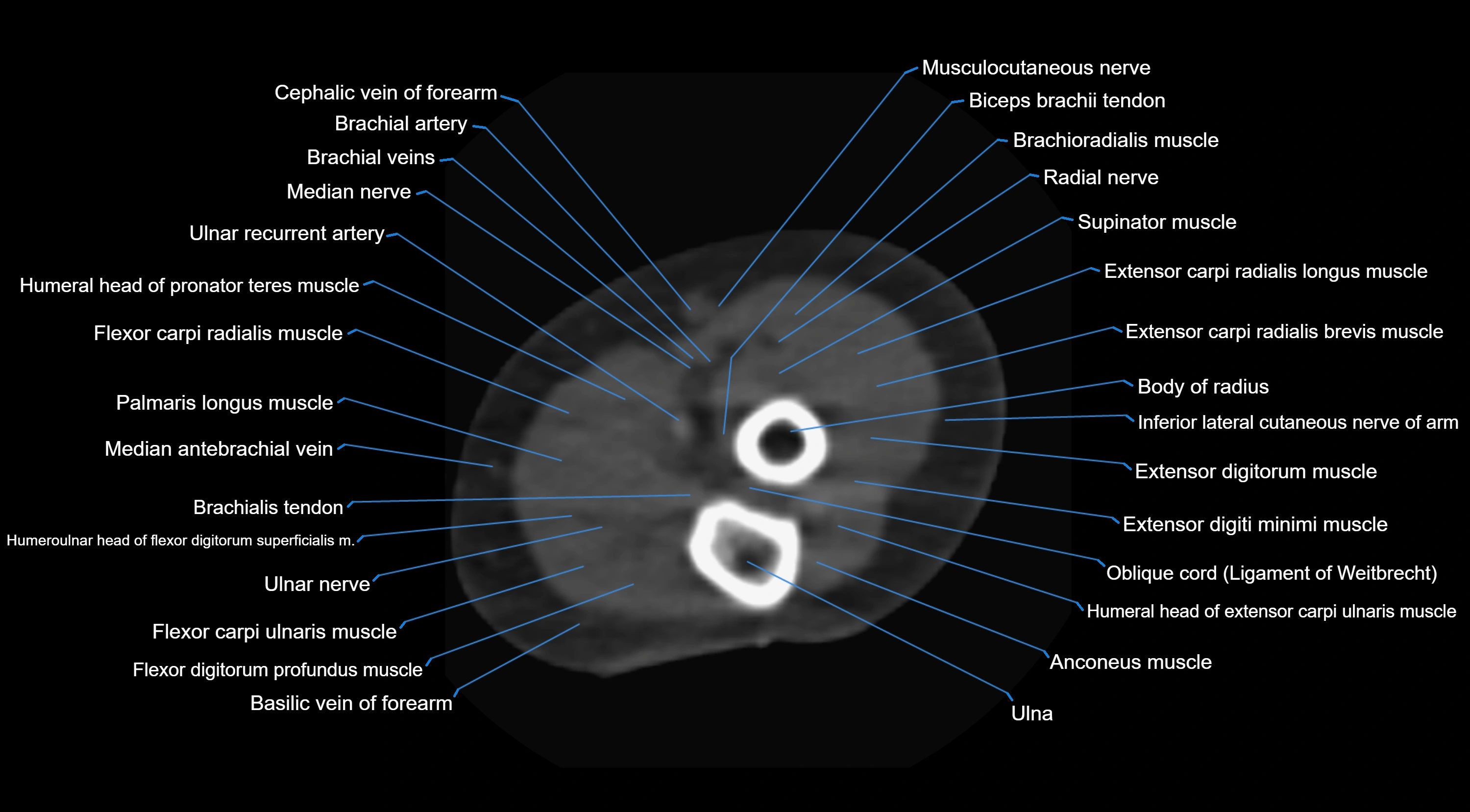 CT elbow axial  cross sectional anatomy labelled  radiology image -00040.webp
